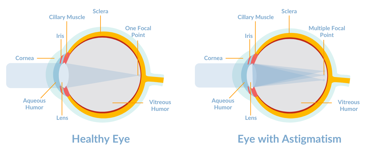 Astigmatism Causes Types Symptoms And Treatment Smartbuyglasses Ca