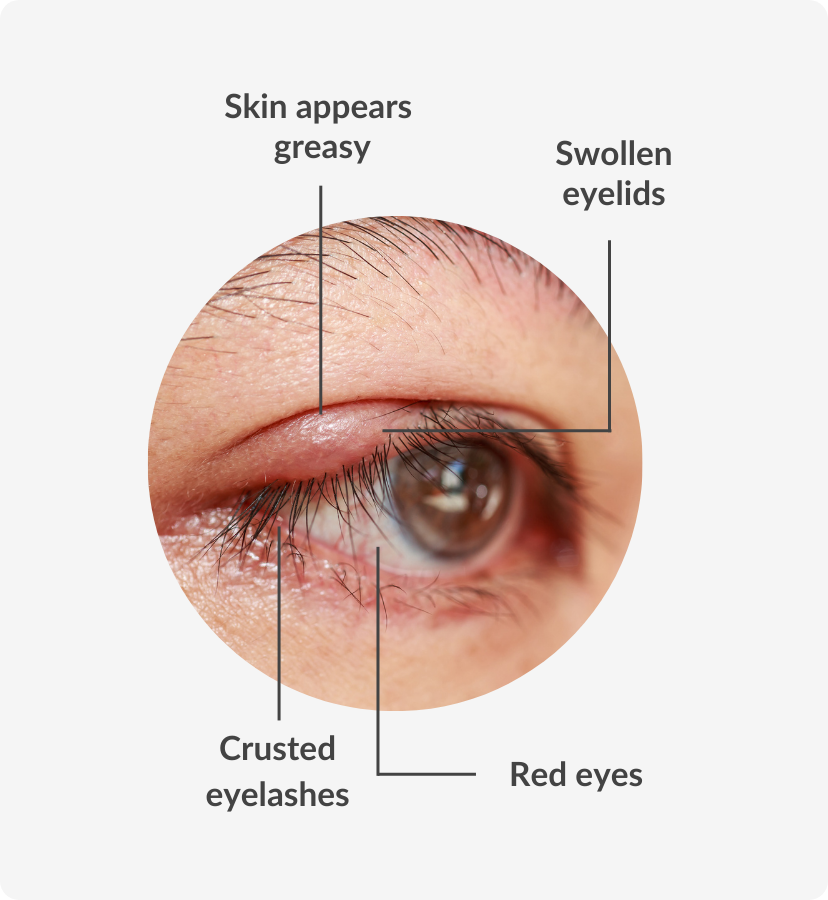 Blepharitis Symptoms Causes And Possible Treatments Smartbuyglasses Ca 